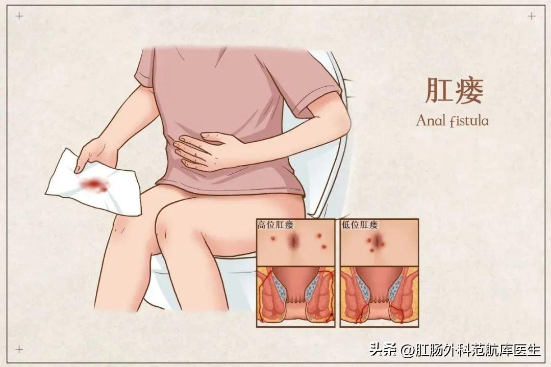 🌟肛瘘最新治疗方法揭秘与解析🌟